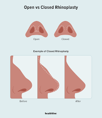 عمل جراحی مجدد زیبایی بینی (رینوپلاستی)