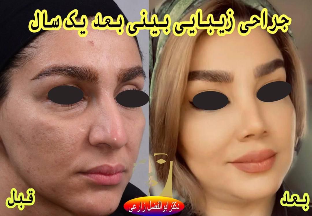 جراحی انحراف بینی (سپتوپلاستی) دکتر ابوالفضل زارعی در تهران 4