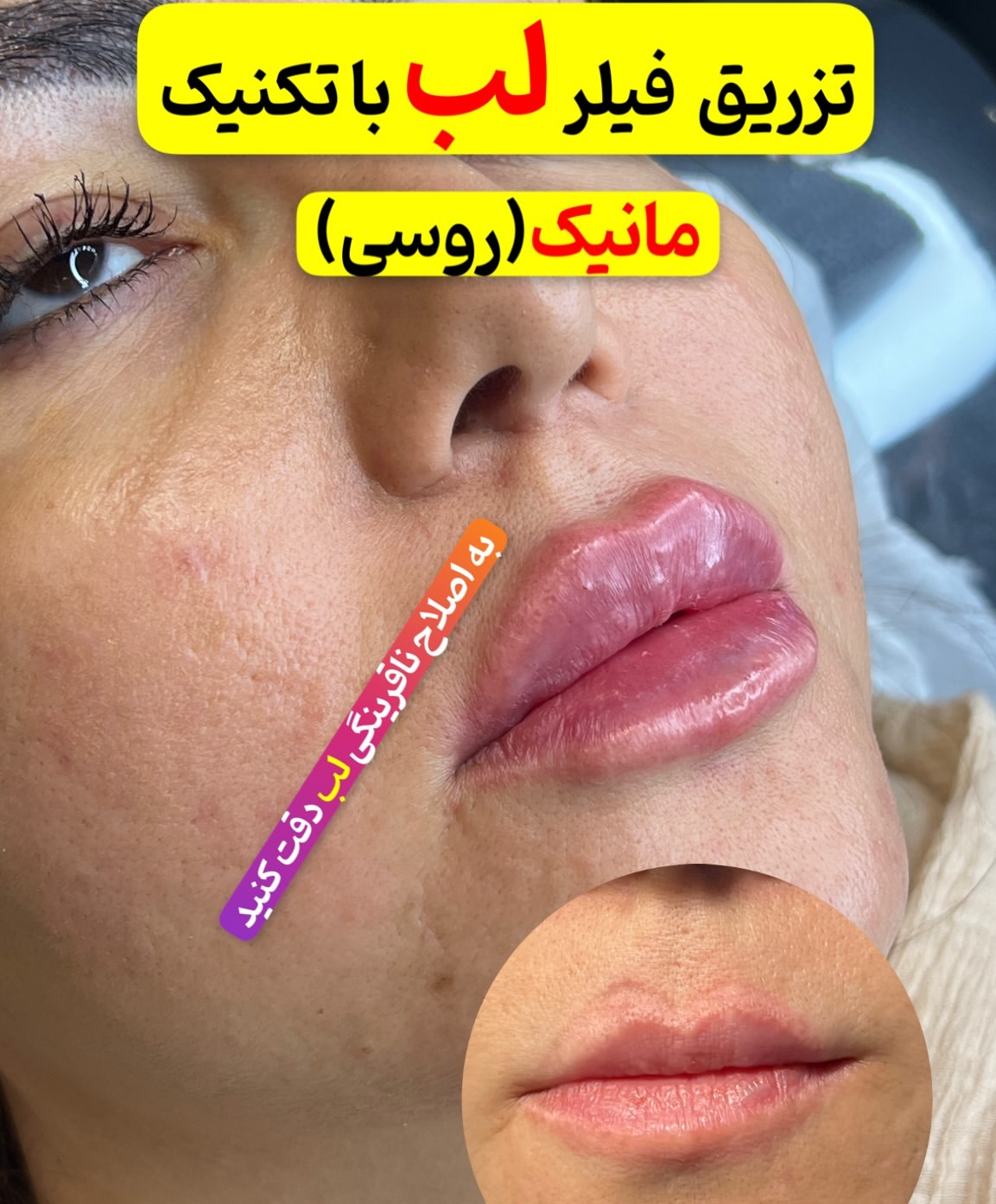 تزریق ژل لب با برند اینوسنس (1CC) مرکز زیبایی مانیک شعبه اندیشه در اندیشه 4