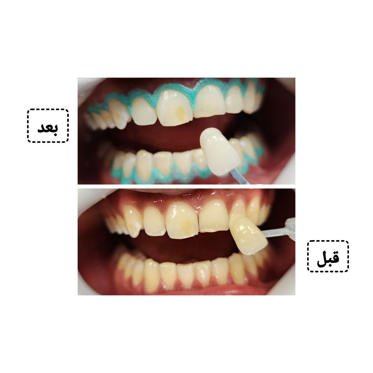 آفیس بلیچینگ (سفید کردن دندان) دو فک با مواد آمریکایی دکتر مریم علوی در تهران 5