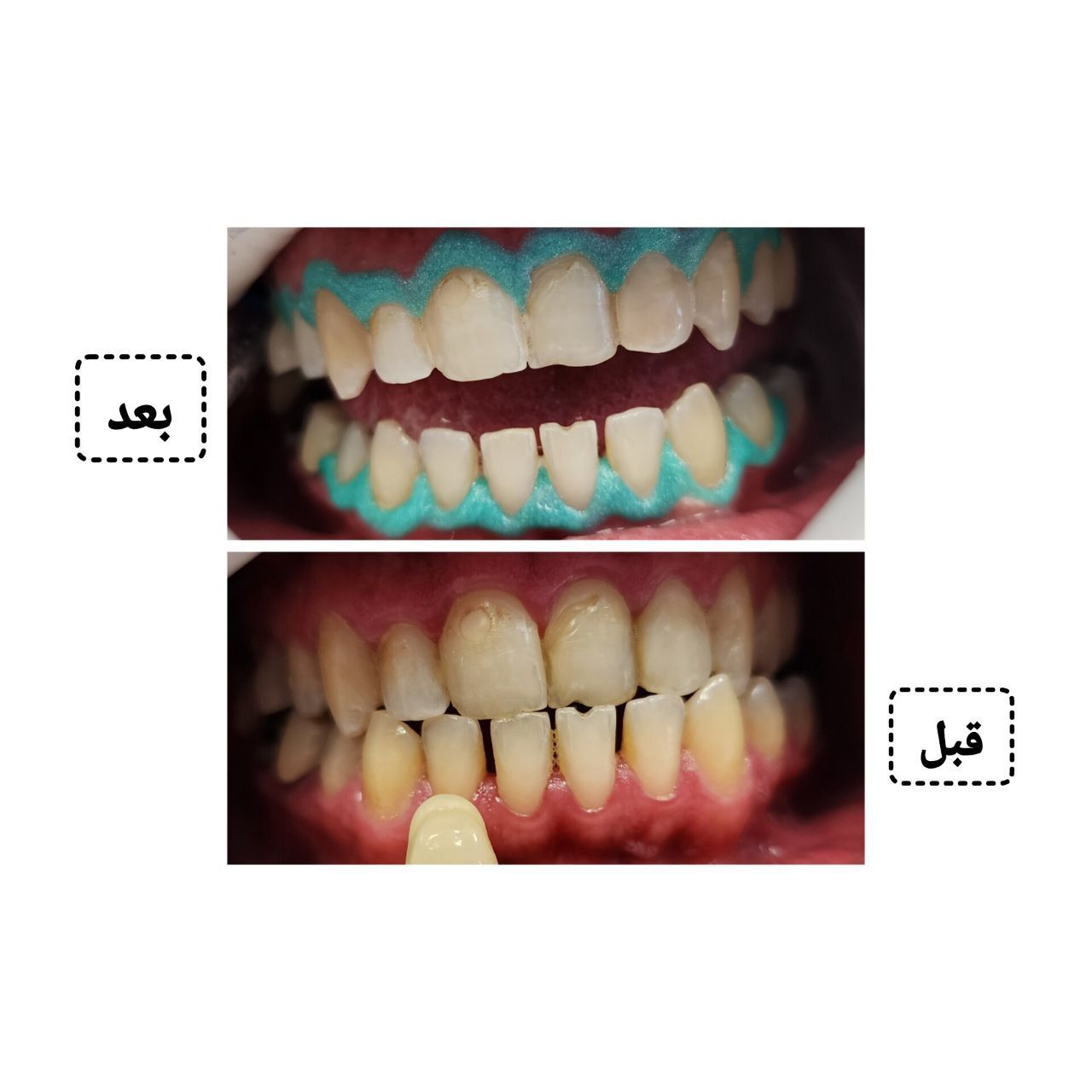 آفیس بلیچینگ (سفید کردن دندان) دو فک با مواد آمریکایی دکتر مریم علوی در تهران 4