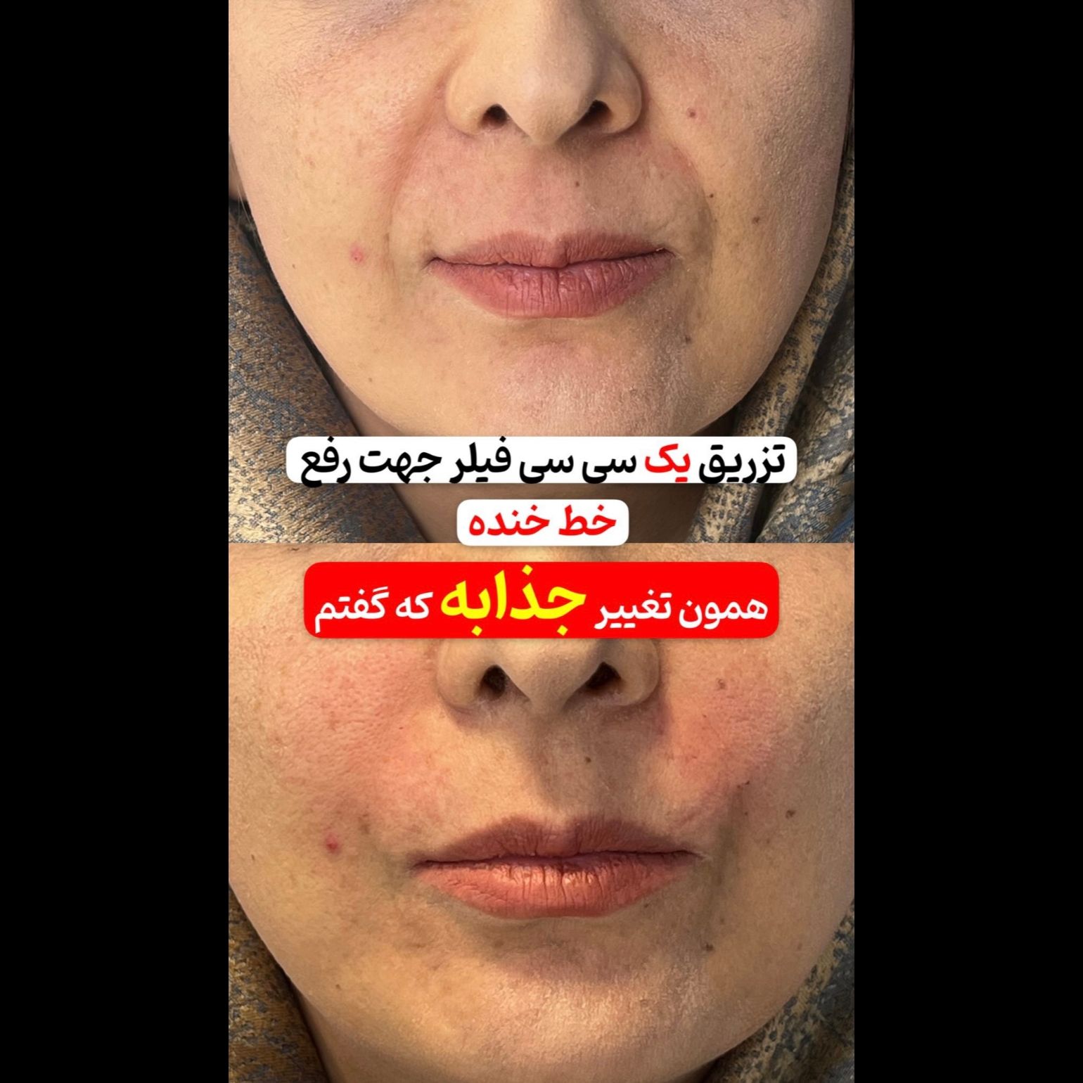 تزریق ژل خط خنده با برند نورامیس(1CC) مرکز زیبایی مانیک شعبه اندیشه در اندیشه 1