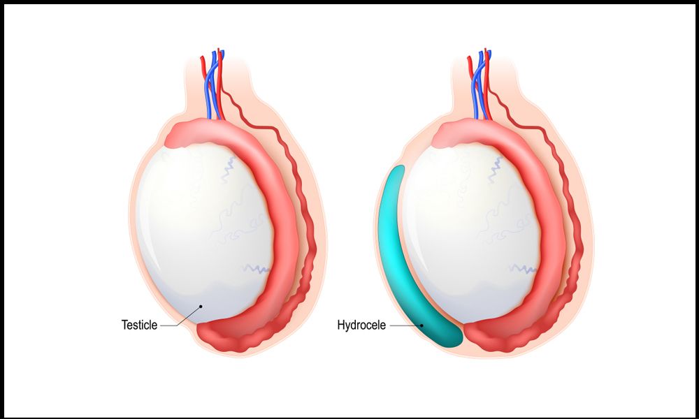 جراحی هیدروسل بیضه