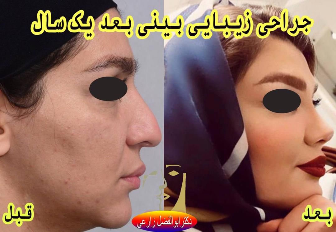 جراحی انحراف بینی (سپتوپلاستی) دکتر ابوالفضل زارعی در تهران 5