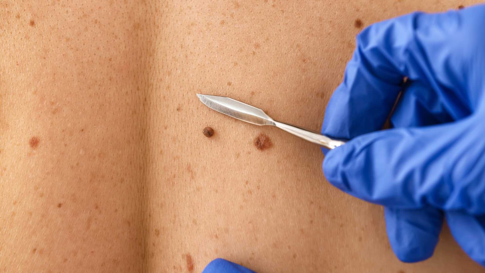 برداشتن ضایعات پوستی (skin tags) به روش کرایوتراپی