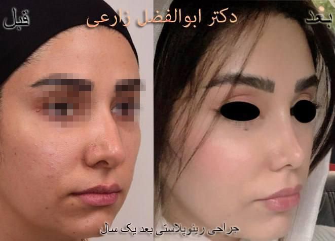 جراحی انحراف بینی (سپتوپلاستی) دکتر ابوالفضل زارعی در تهران 6