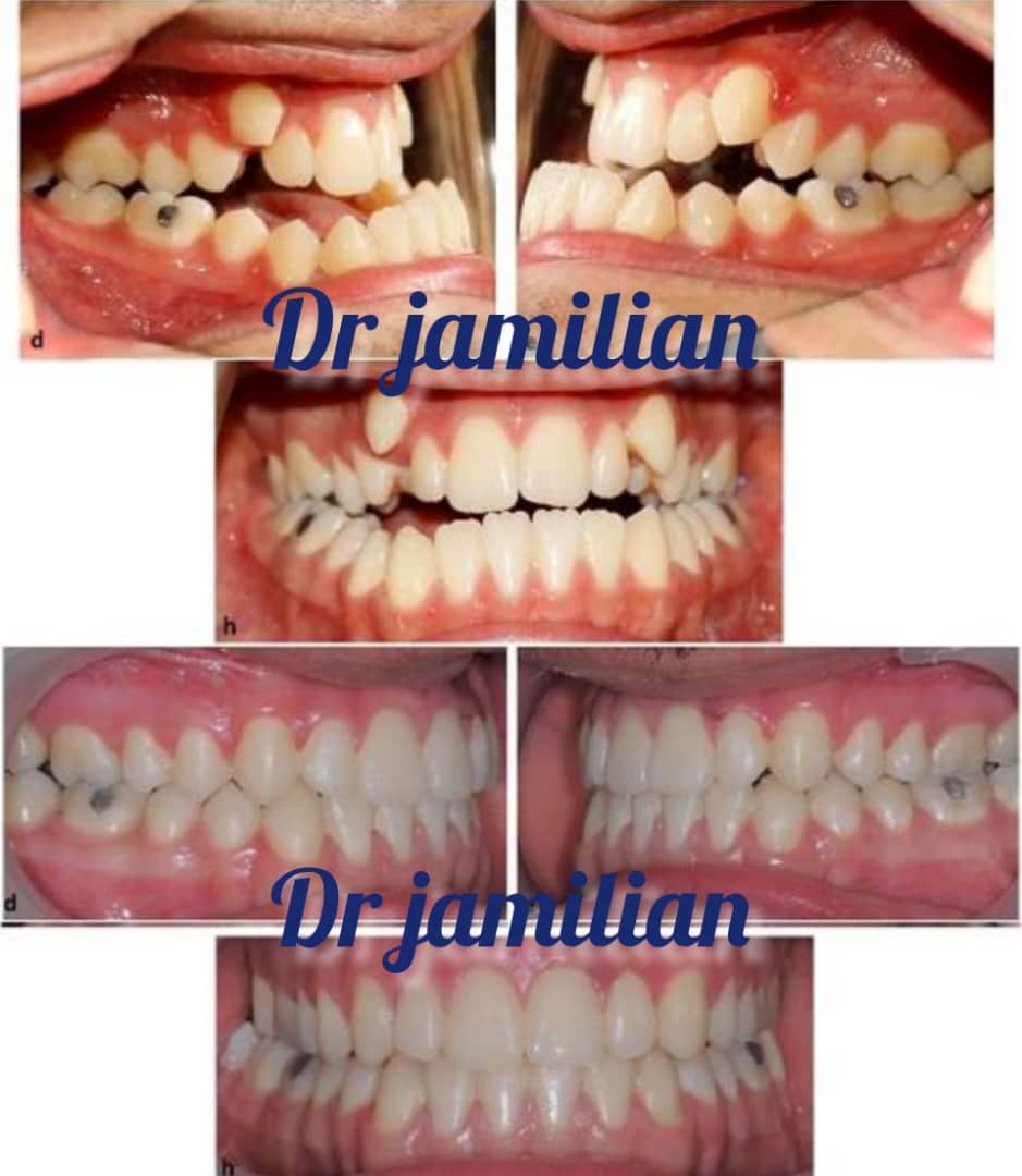 ارتودنسی ثابت (هر فک) دکتر عبدالرضا جمیلیان در تهران 3