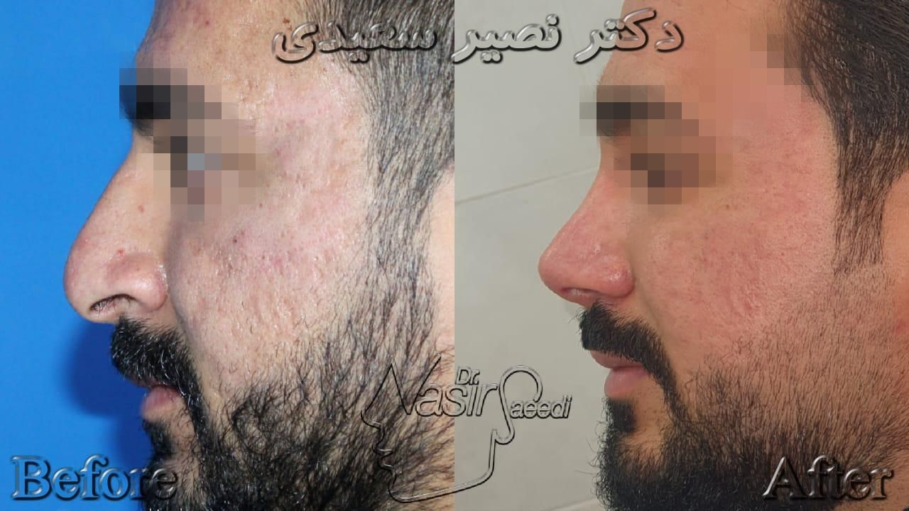 عمل زیبایی بینی (رینوپلاستی)