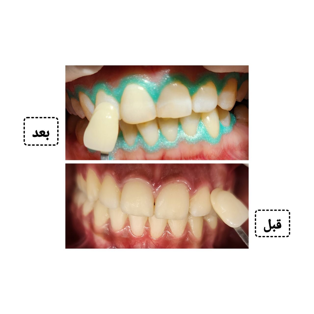 هوم بلیچینگ (سفید کردن دندان) دو فک با مواد آمریکایی دکتر مریم علوی در تهران 3