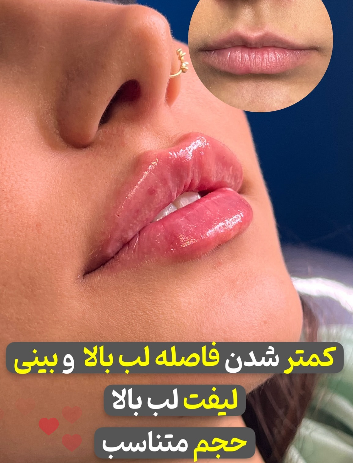 تزریق ژل لب با برند پلوریال(1CC) مرکز زیبایی مانیک شعبه اندیشه در اندیشه 2