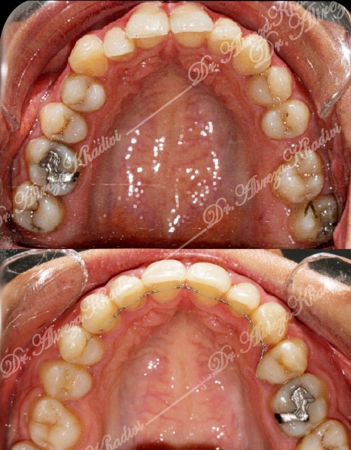 مشاوره ارتودنسی ثابت دکتر علیرضا خدیوی در تهران 3