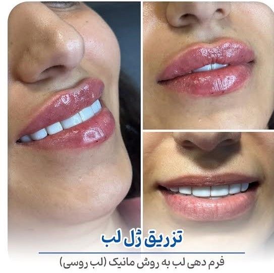 تزریق ژل لب با برند اینوسنس (1CC) مرکز زیبایی مانیک شعبه اندیشه در اندیشه 2