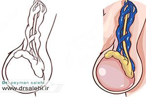 جراحی واریکوسل