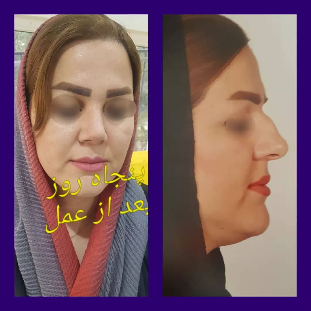 عمل جراحی مجدد زیبایی بینی (رینوپلاستی)