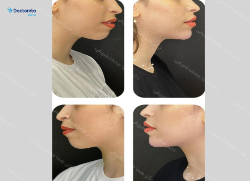 تزریق ژل چانه با برند استایلج ( 1cc)