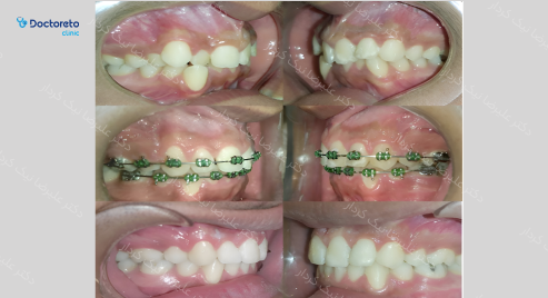 ارتودنسی ثابت (دو فک) دکتر علیرضا نیک کردار در تهران 29