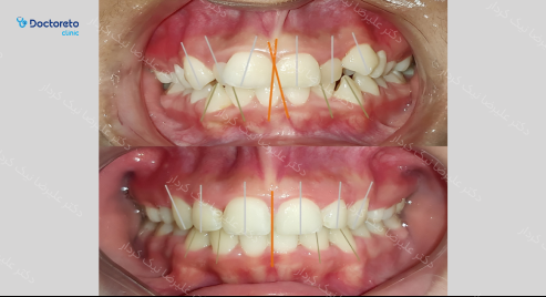 ارتودنسی ثابت (دو فک) دکتر علیرضا نیک کردار در تهران 32