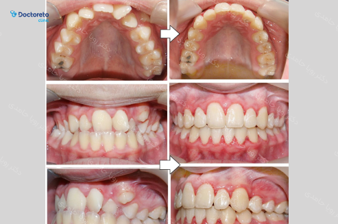 ارتودنسی متحرک (دو فک) دکتر رویا حامدی در تهران 11