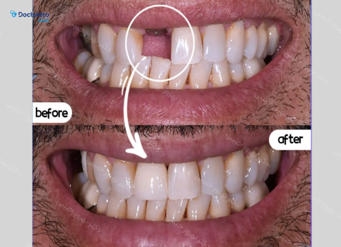 ایمپلنت نئودنت سوئیسی به همراه روکش تمام سرامیکی (هر واحد) دکتر بهروز حبیبی در تهران 3