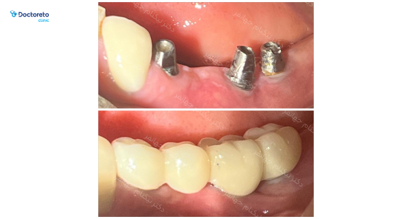 ایمپلنت ایرانی آویتا (Avita) با روکش زیر کونیا دکتر نیکنام جهانفر در کرج 3