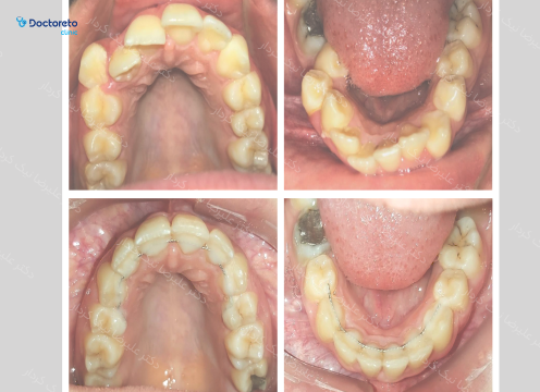 ارتودنسی ثابت (دو فک) دکتر علیرضا نیک کردار در تهران 45