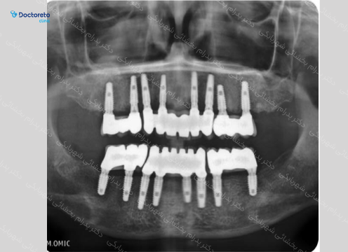 ایمپلنت core1 کره ای با روکش (هر واحد) دکتر پدرام بخشائی شهربابکی در تهران 7