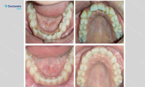 نگه دارنده ی ثابت ارتودنسی (یک فک) دکتر علیرضا نیک کردار در تهران 8