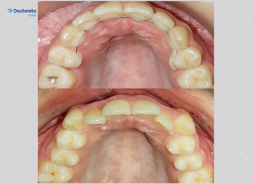 نگه دارنده ی ثابت ارتودنسی (یک فک) دکتر علیرضا نیک کردار در تهران 3