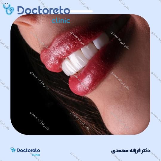 ونیر کامپوزیت توکویاما ژاپنی (هر واحد) دکتر فرزانه محمدی در شیراز 16