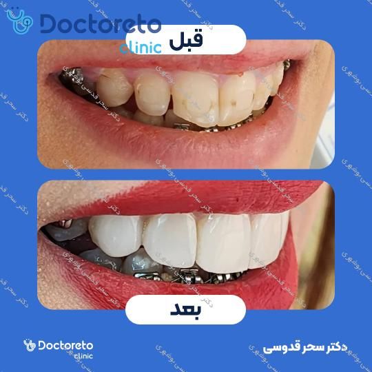 ونیر کامپوزیت توکویاما ژاپنی (هر واحد)