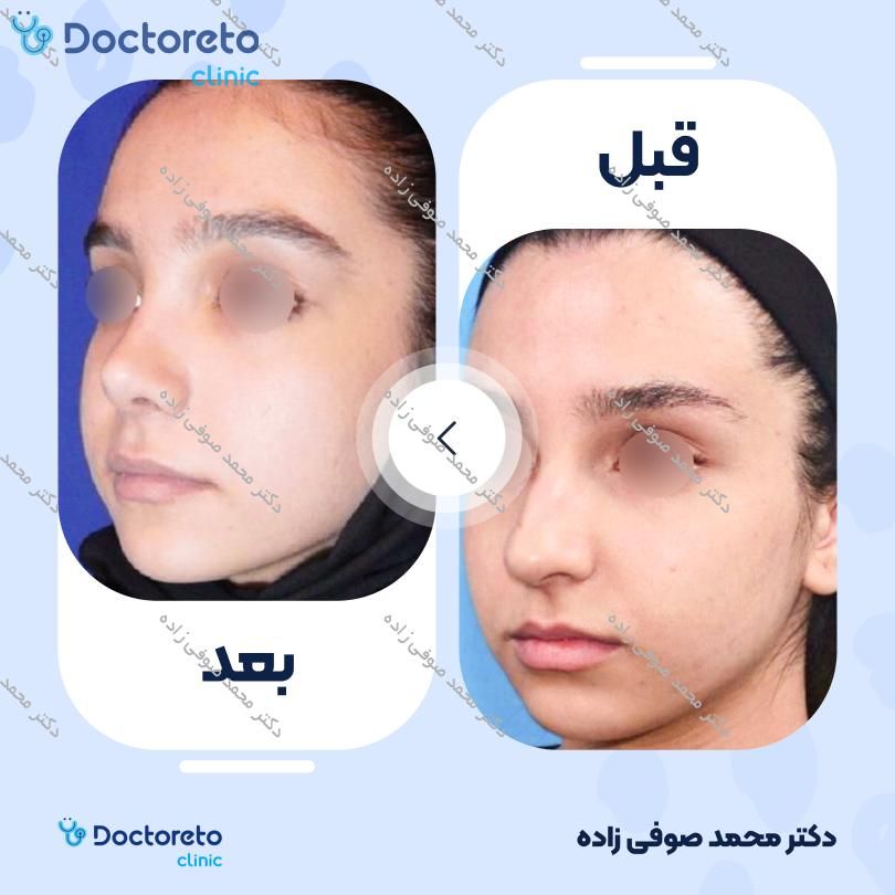 عمل زیبایی بینی (رینوپلاستی) دکتر محمد صوفی زاده در تهران 28