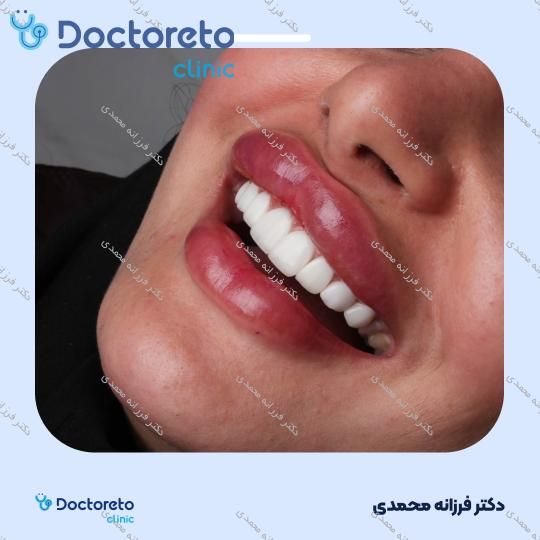 ونیر کامپوزیت توکویاما ژاپنی (هر واحد) دکتر فرزانه محمدی در شیراز 22