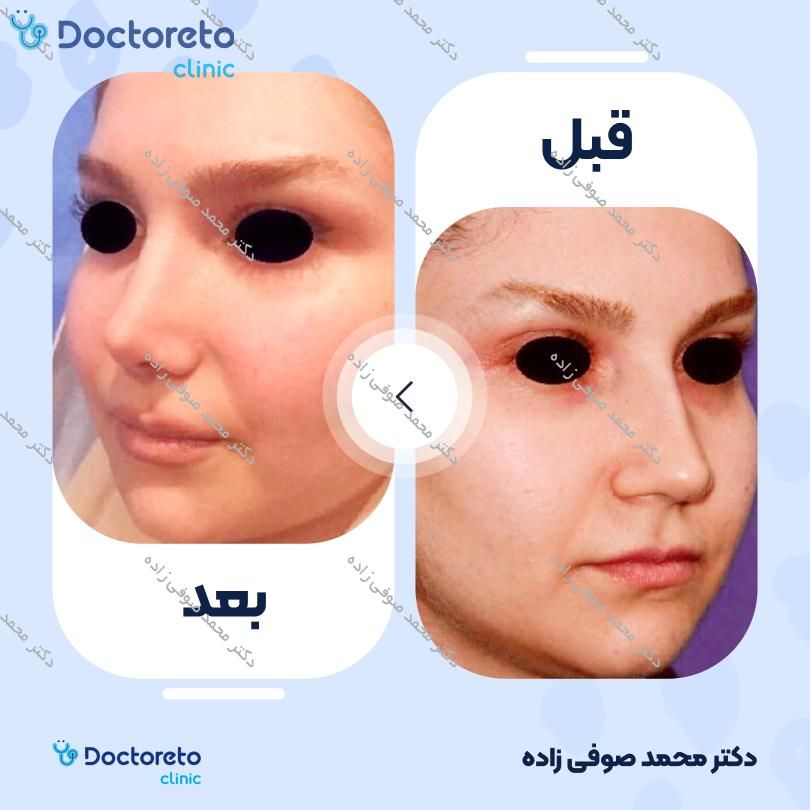 عمل زیبایی بینی (رینوپلاستی) دکتر محمد صوفی زاده در تهران 20