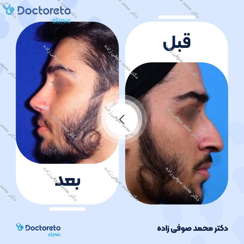 عمل زیبایی بینی (رینوپلاستی) دکتر محمد صوفی زاده در تهران 38
