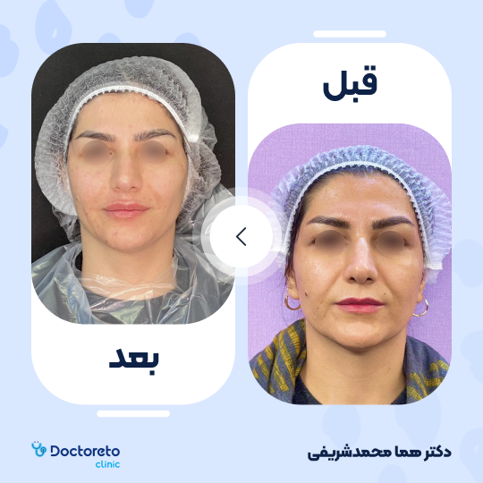 تزریق ژل خط خنده با برند رووفیل (1CC)