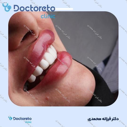 ونیر کامپوزیت توکویاما ژاپنی (هر واحد) دکتر فرزانه محمدی در شیراز 20