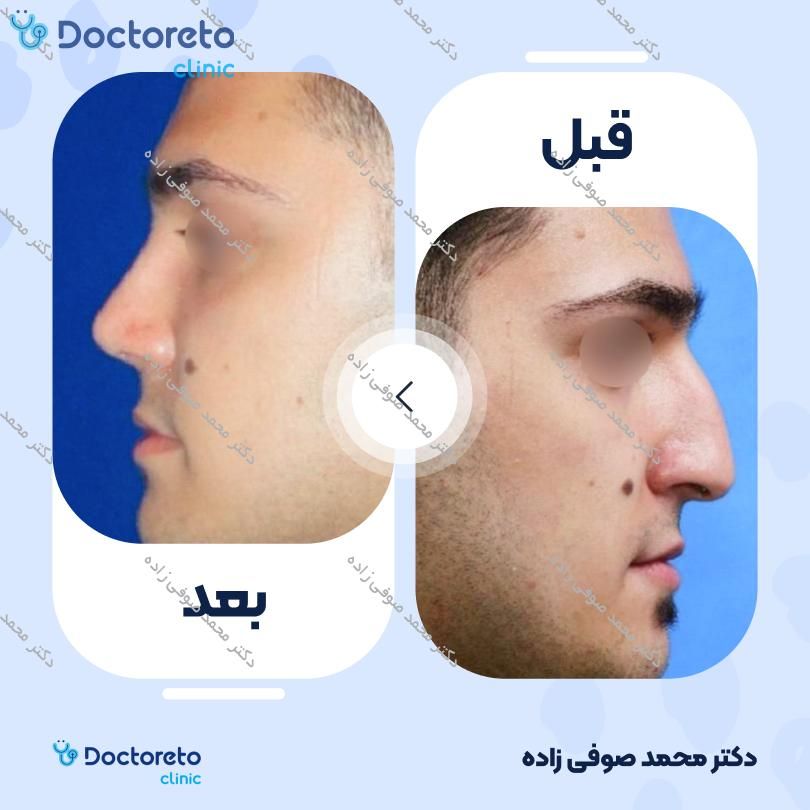 عمل زیبایی بینی (رینوپلاستی) دکتر محمد صوفی زاده در تهران 16