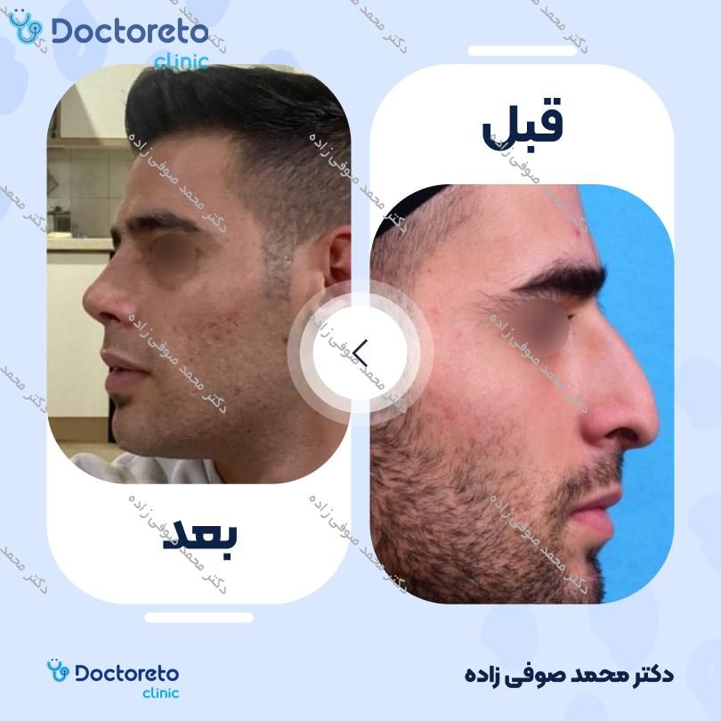 عمل زیبایی بینی (رینوپلاستی) دکتر محمد صوفی زاده در تهران 13