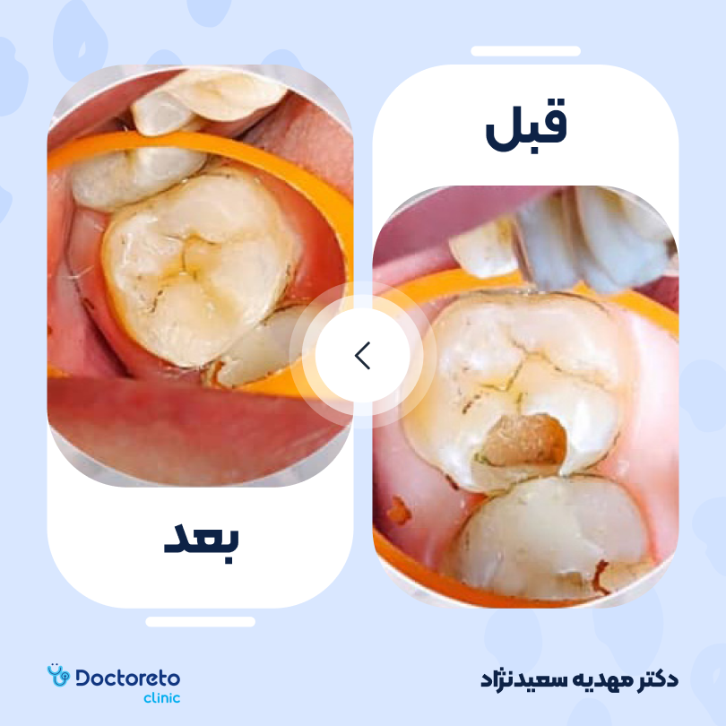 پرکردن دندان سه سطحی با کامپوزیت آمریکایی دکتر مهدیه سعیدنژاد در تهران 4