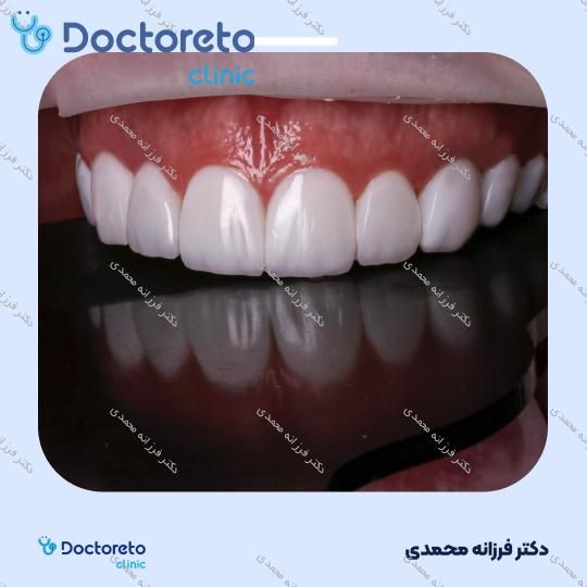 ونیر کامپوزیت سارمکو سوئیسی (هر واحد)
