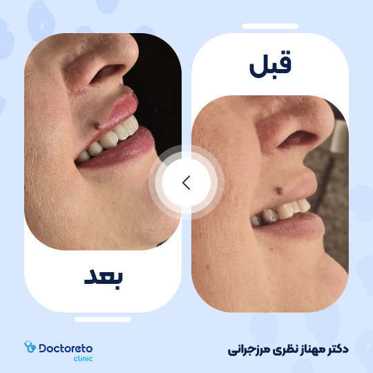 لمینت پرسلنی ایمکس (هر واحد) دکتر مهناز نظری مرزجرانی در اراک 4