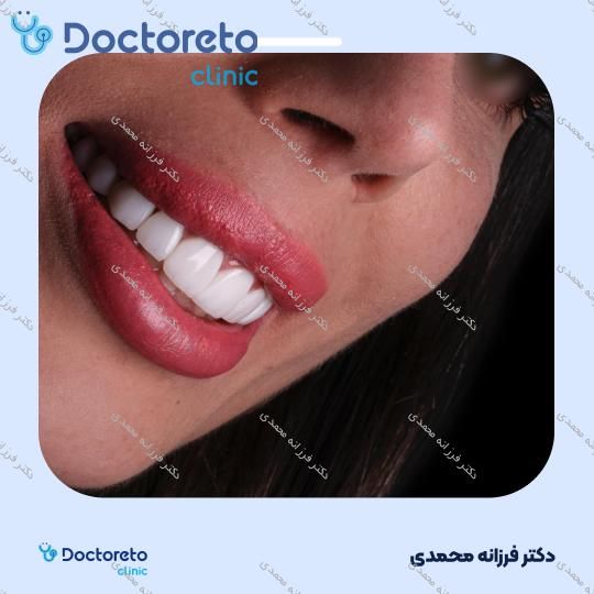 ونیر کامپوزیت توکویاما ژاپنی (هر واحد) دکتر فرزانه محمدی در شیراز 11