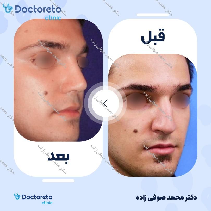 جراحی انحراف بینی (سپتوپلاستی) دکتر محمد صوفی زاده در تهران 15