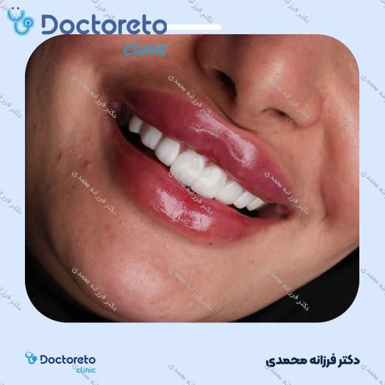 ونیر کامپوزیت توکویاما ژاپنی (هر واحد) دکتر فرزانه محمدی در شیراز 18