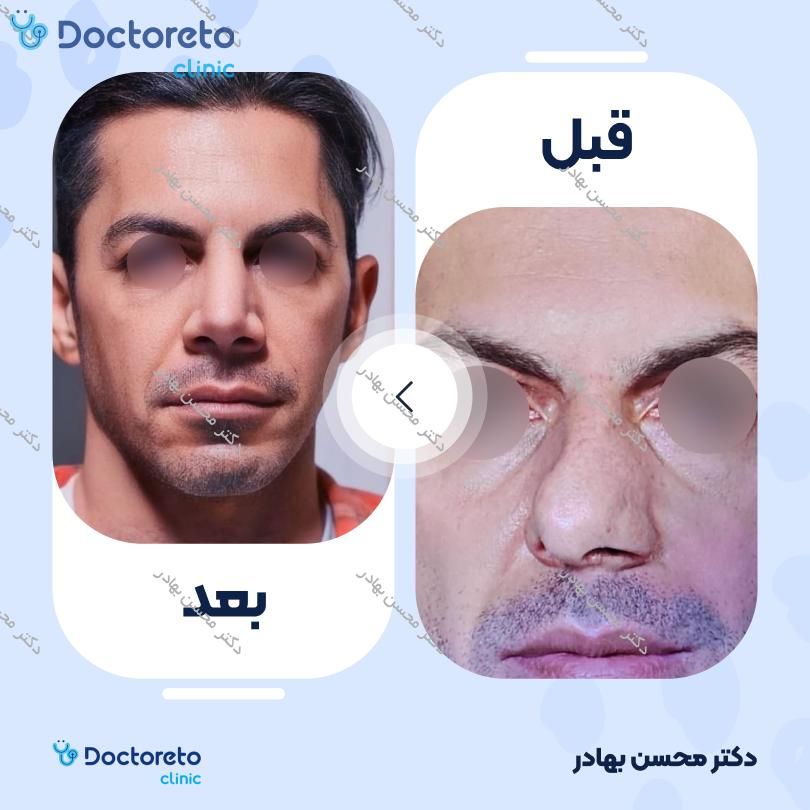 جراحی انحراف بینی (سپتوپلاستی) دکتر محسن بهادر در مرودشت 9