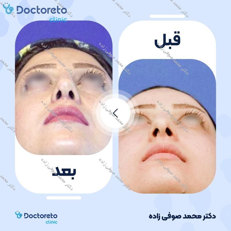 عمل زیبایی بینی (رینوپلاستی) دکتر محمد صوفی زاده در تهران 18