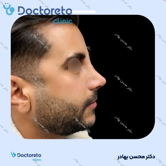 عمل جراحی مجدد زیبایی بینی (رینوپلاستی) دکتر محسن بهادر در شیراز 10