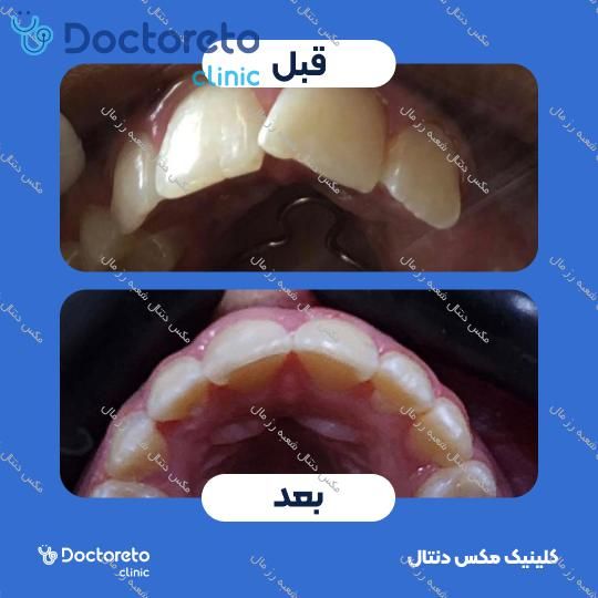 ارتودنسی متحرک (دو فک) مکس دنتال شعبه رز مال در تهران 5