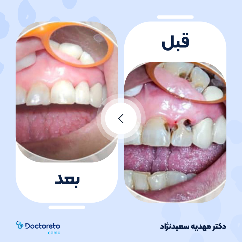 پرکردن دندان یک سطحی با کامپوزیت آمریکایی دکتر مهدیه سعیدنژاد در تهران 5