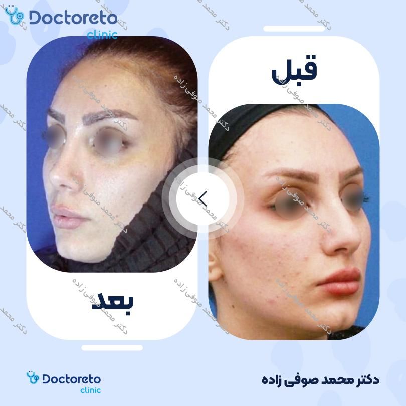 عمل زیبایی بینی (رینوپلاستی) دکتر محمد صوفی زاده در تهران 35